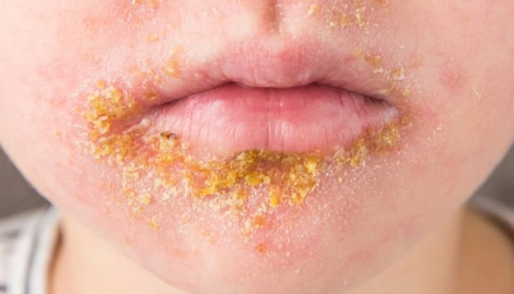 Impetigo