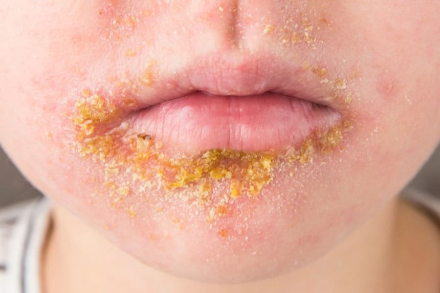 Impetigo