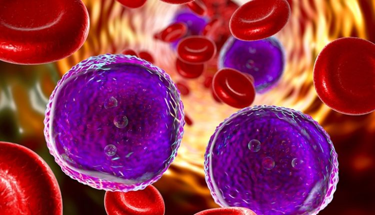Acute lymphocytic leukaemia is a cancer that affects a particular type of white blood cell, the lymphocyte. Lymphocytes fight infections and are produced by the bone marrow, which normally generates enough of them for the body's needs