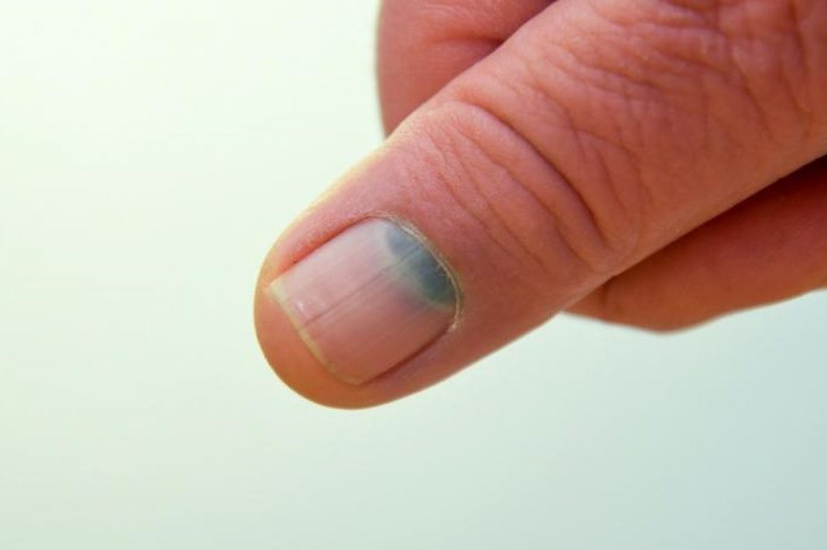 Nail melanoma: prevention and early diagnosis | Emergency Live Nail melanoma: prevention and early diagnosis | Emergency Live