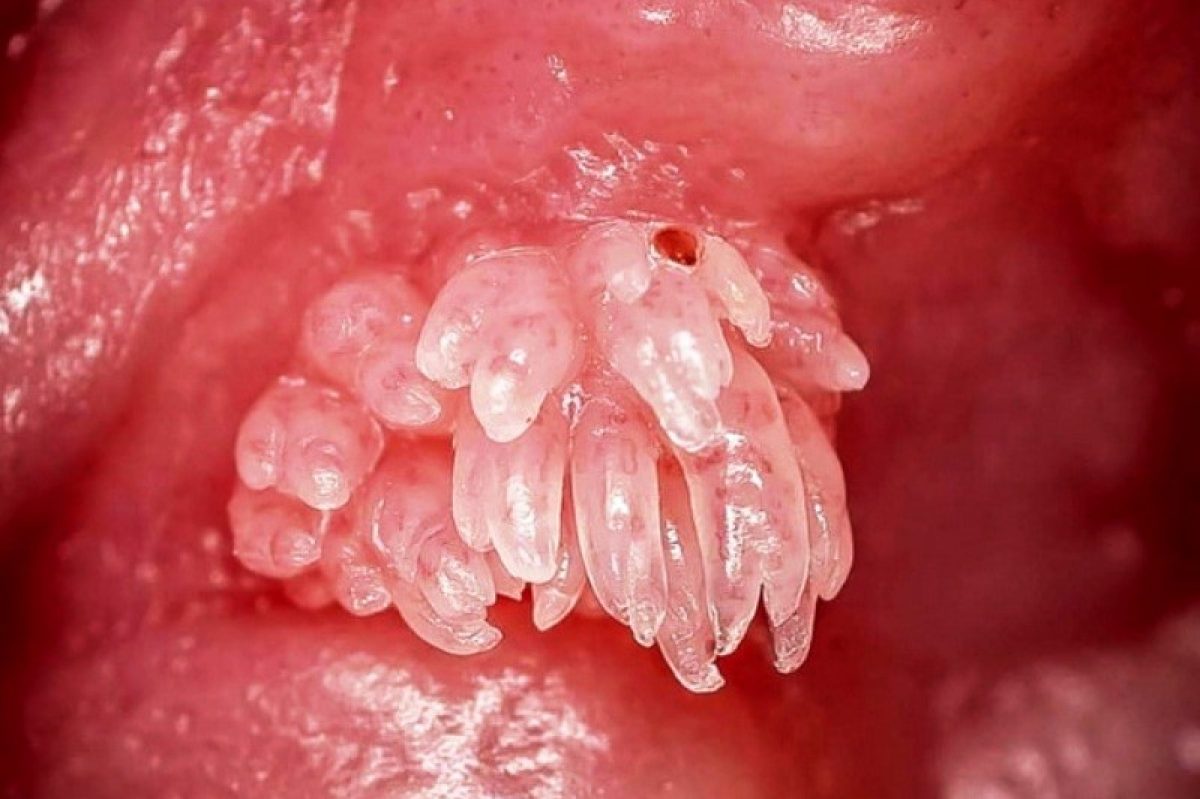 Infecția Cu Papilomavirus Uman Cauze Simptome și Tratament Infecția și prevenirea cu virusul papiloma | Urgență Live