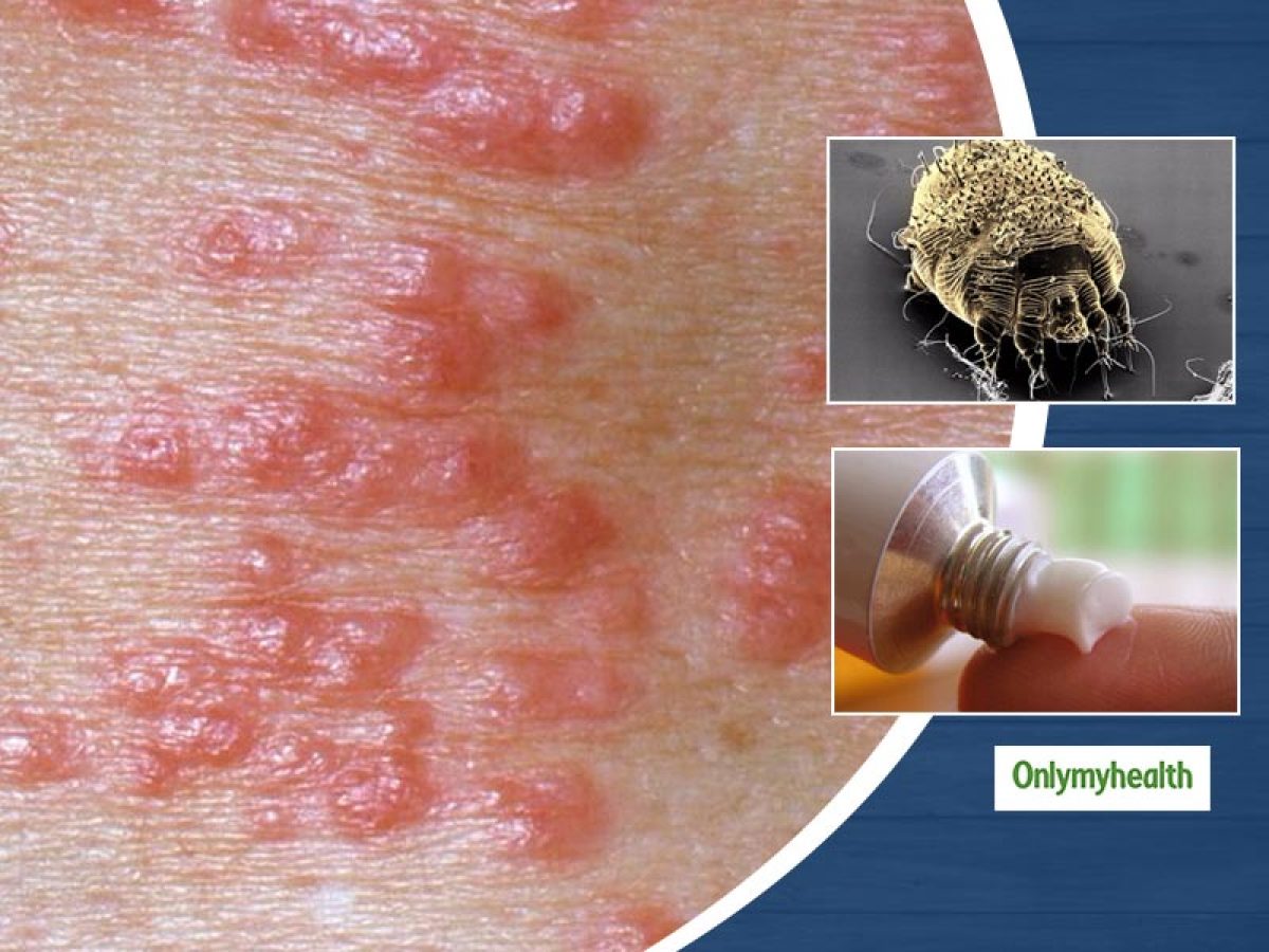 How to identify scabies atelier yuwa ciao jp