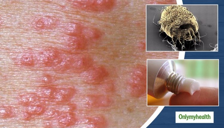 Scabies: symptoms and treatment of Sarcoptes scabiei infection