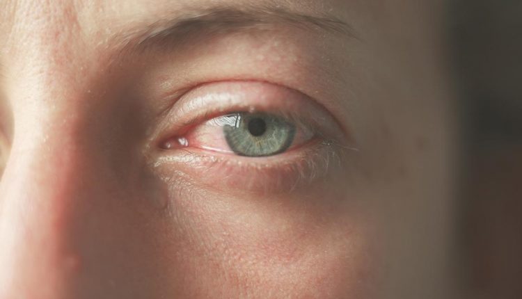 Keratitis is an inflammation of the cornea that can be caused by a viral infection or by traumatic events. To treat it, the cause must be traced