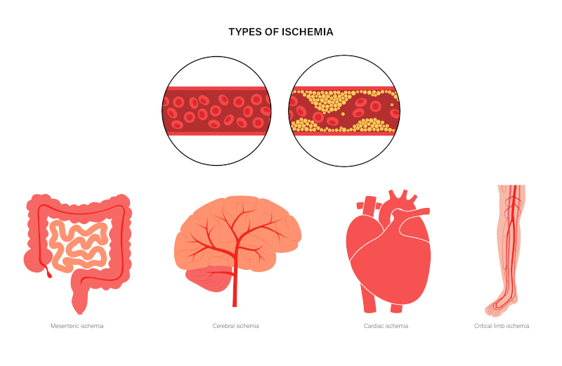 Types of ishemia
